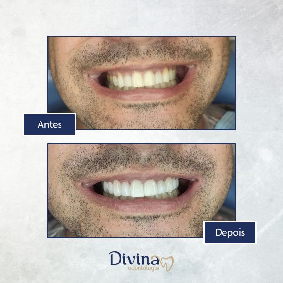 Caso clínico Divina Odontologia - Tratamento odontológico 2