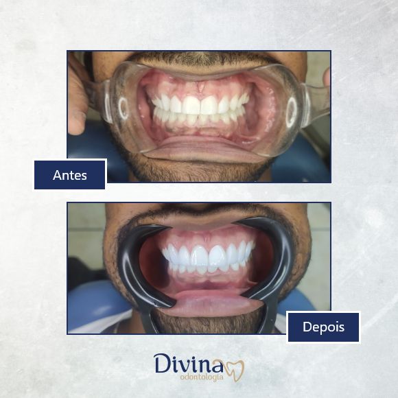 Caso clínico Divina Odontologia - Tratamento odontológico 3