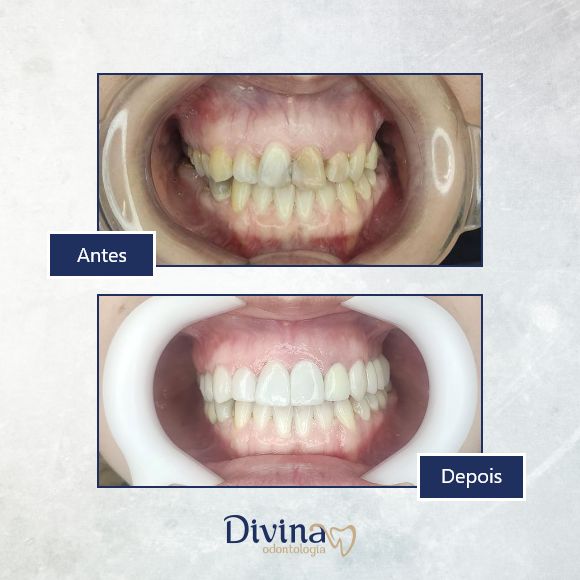 Caso clínico Divina Odontologia - Tratamento odontológico 6