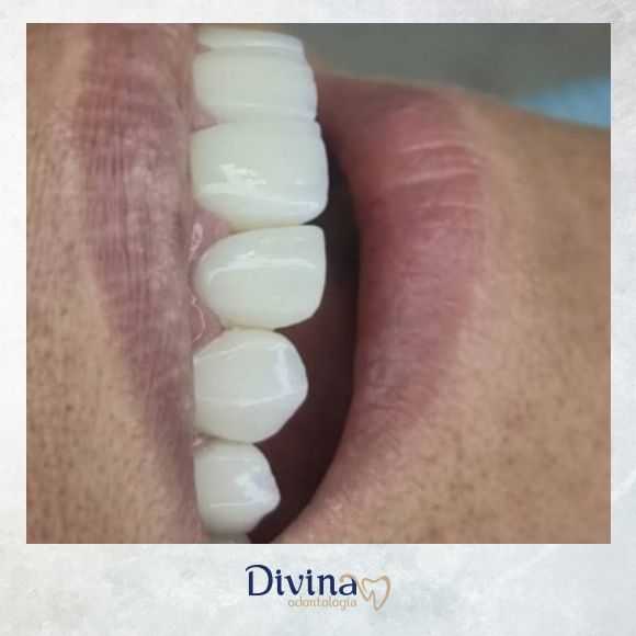 Caso clínico Divina Odontologia - Tratamento odontológico 7